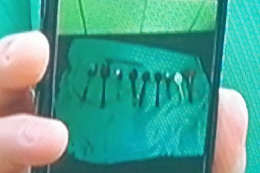 Pacijent se žalio na užasne bolove! Lekari mu našli 9 kašika i četkicu za zube! Odmah operisan! (FOTO)