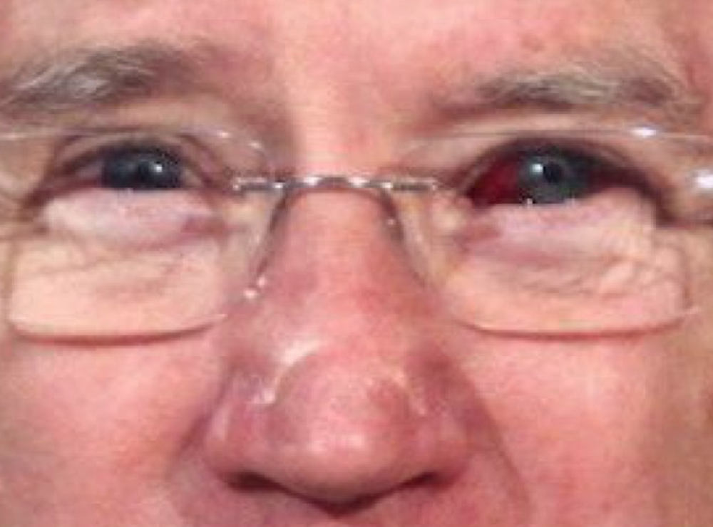 U toku javne debate u oku mu se pojavila krv! Sad se ceo svet pita samo jedno! (VIDEO)