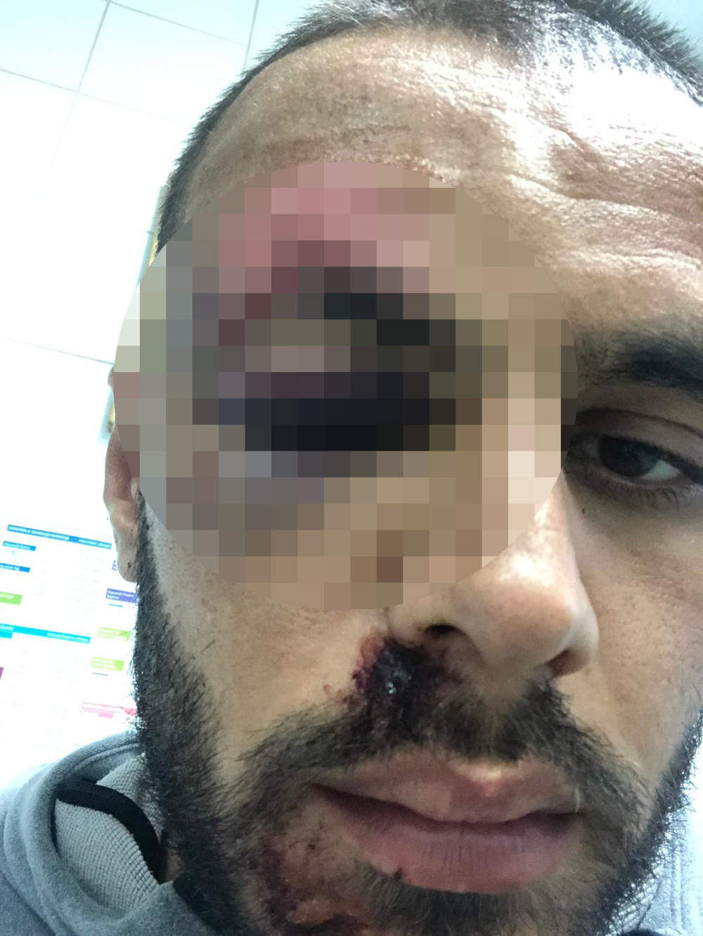 Stradao fudbaler, užasne rane i zatvoreno oko! Još jedno brutalno nasilje komšija (FOTO)