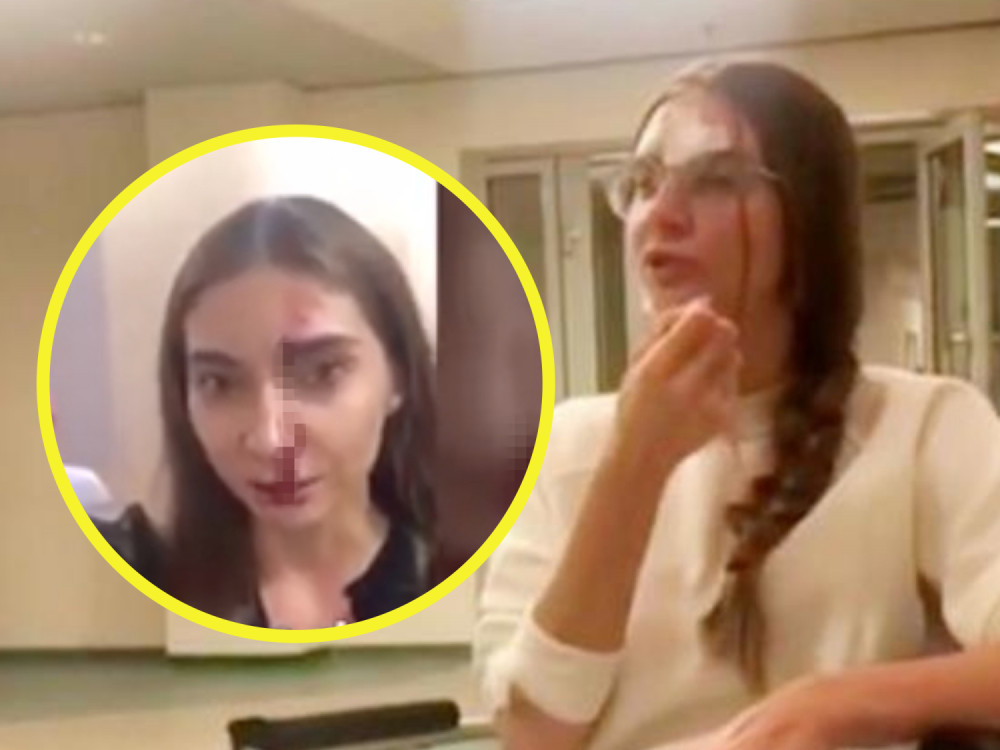 Doktorka isprebijala poznatu pevačicu! Pacijentkinja došla da koriguje usne, a onda joj od udaraca šikljala krv!