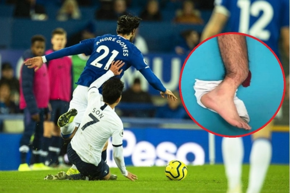 VEOMA JEZIVO! Pojavila se fotografija slomljene noge Gomeša, nije za one sa slabim želucem! (FOTO)