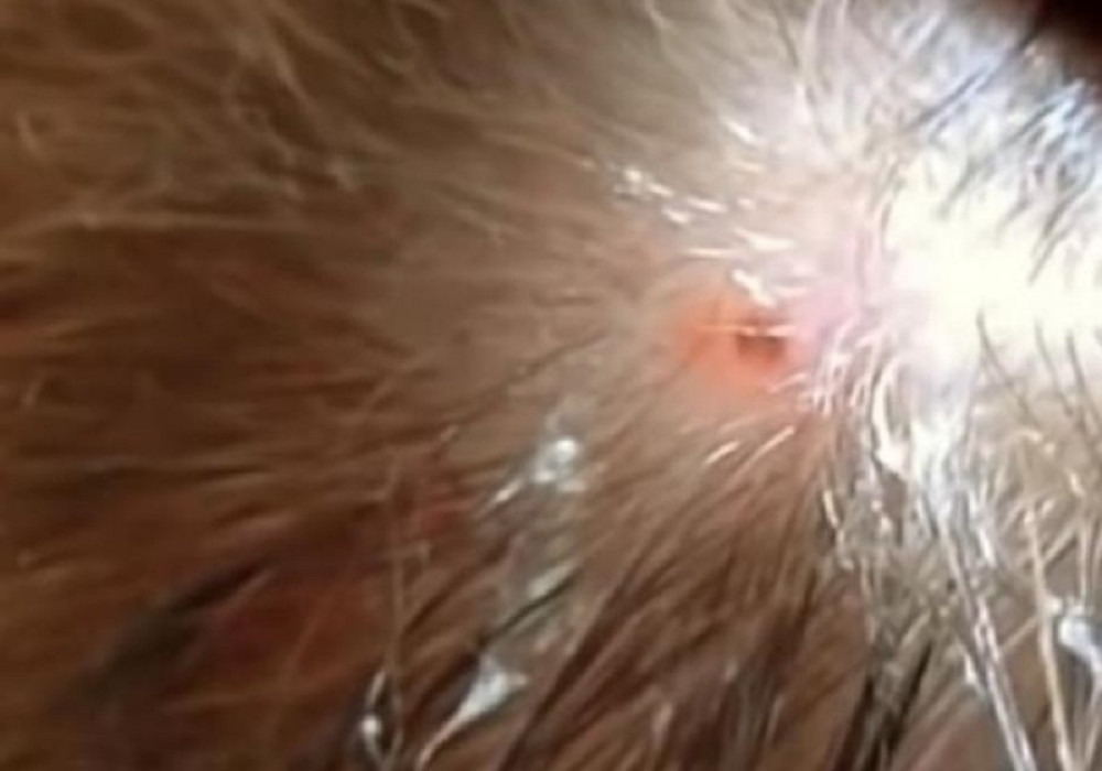 Učitelj otišao na odmor, insekt ga je ujeo za glavu, a mesec dana kasnije umro je u najgorim mukama! (FOTO)