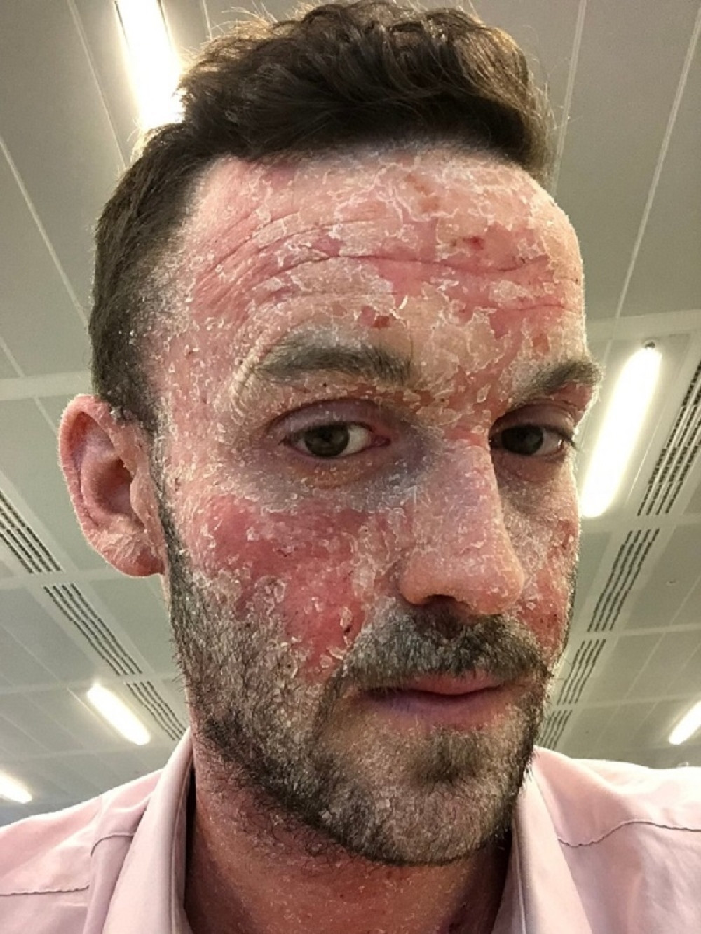 Godinama se borio sa bolnim ekcemima, a onda je odlučio: Odbacio sam sve kreme!