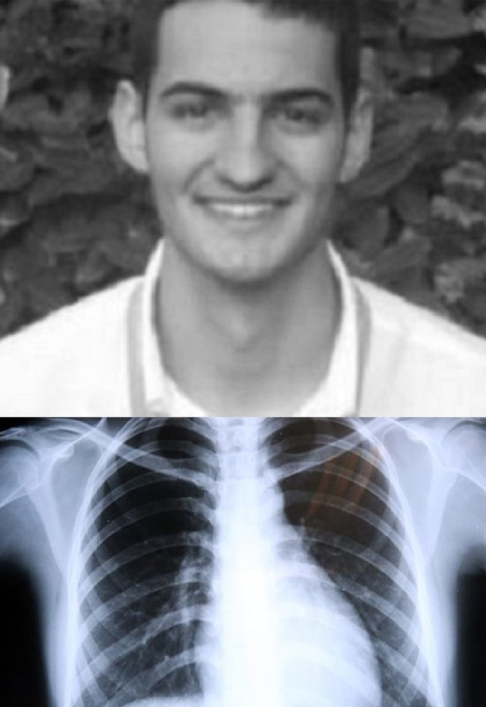 Od nje je preminuo student Mihajlo, a ovo su znaci kada mora da se reaguje ili će biti kasno!