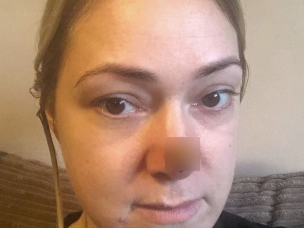 Više nije mogla samu sebe da gleda! Pojavila joj se jedna tačkica na nosu i od tada kreće njena životna borba!