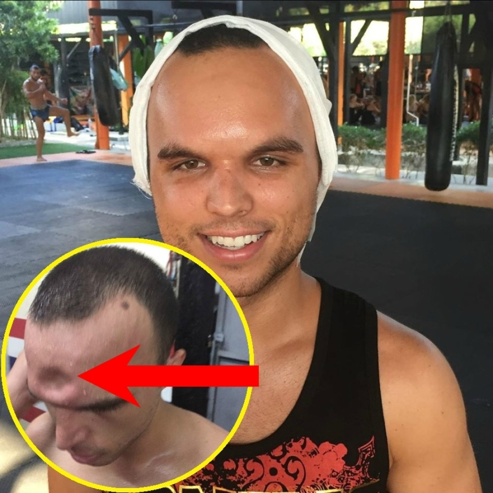 Jezivi snimak povrede, dobio lakat u čelo koji je napravio udubljenje, a bokser nastavio da se bije kao da se ništa nije dogodilo! (VIDEO)