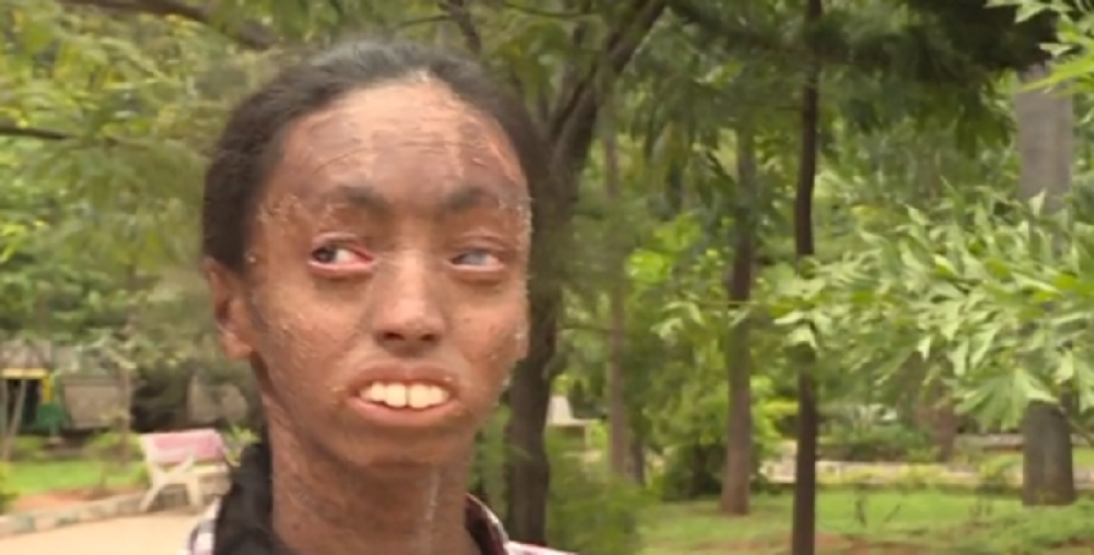 Rodila se sa poremećajem, ali ne odustaje (VIDEO)