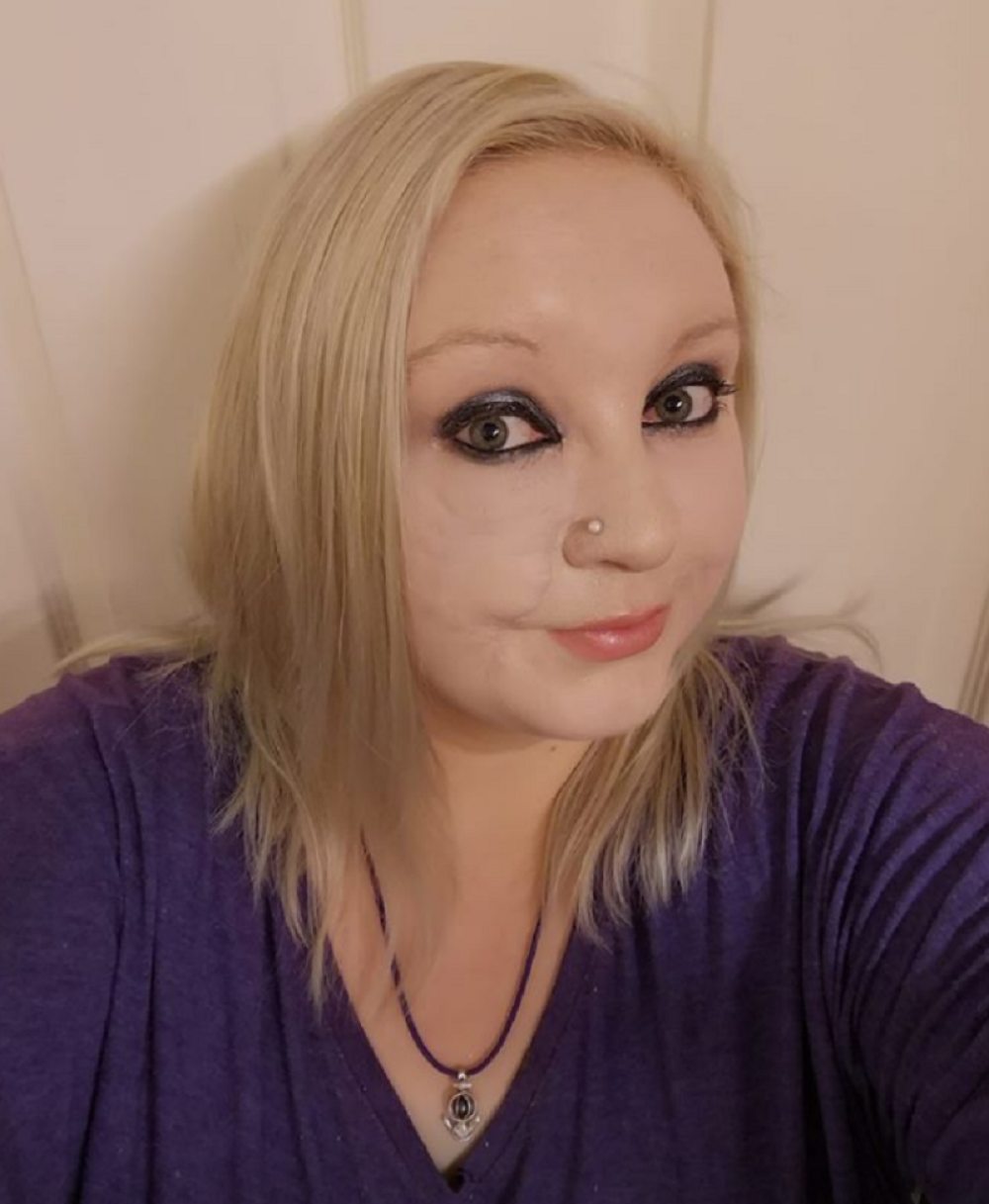 Ostao joj ožiljak na licu od boginja, a onda se to pretvorilo u rak! Njeno lice sada izgleda jezivo