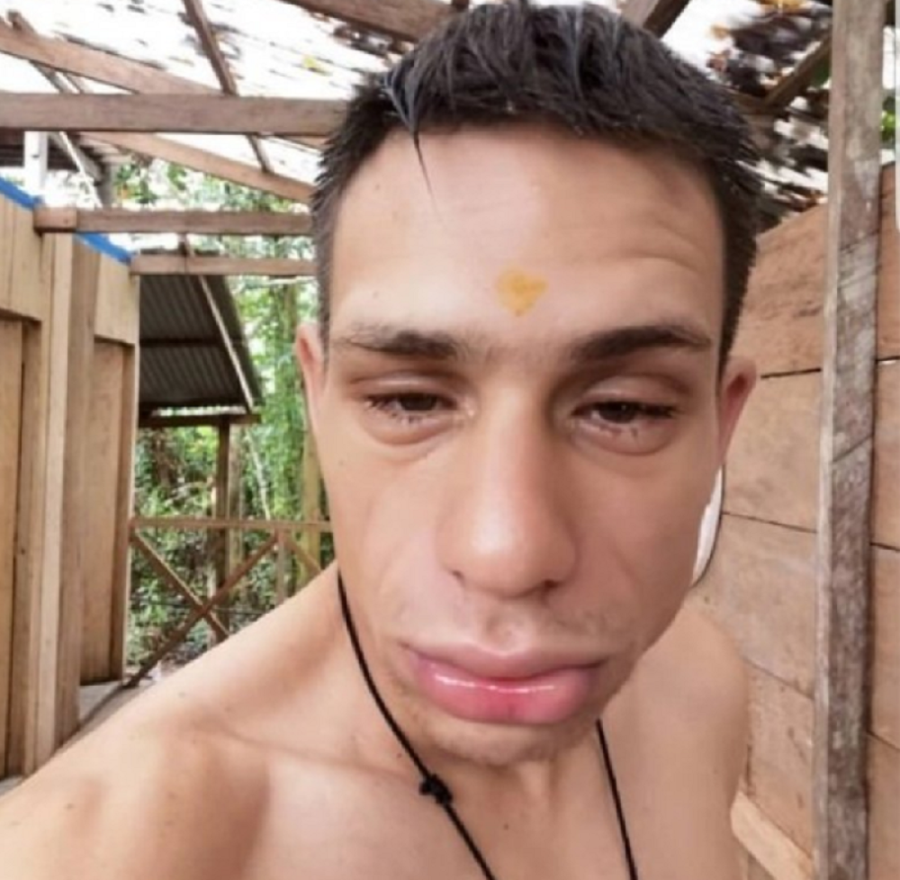 Srpski glumac unakažen nakon bizarnog tretmana sa sluzi žabe (FOTO)