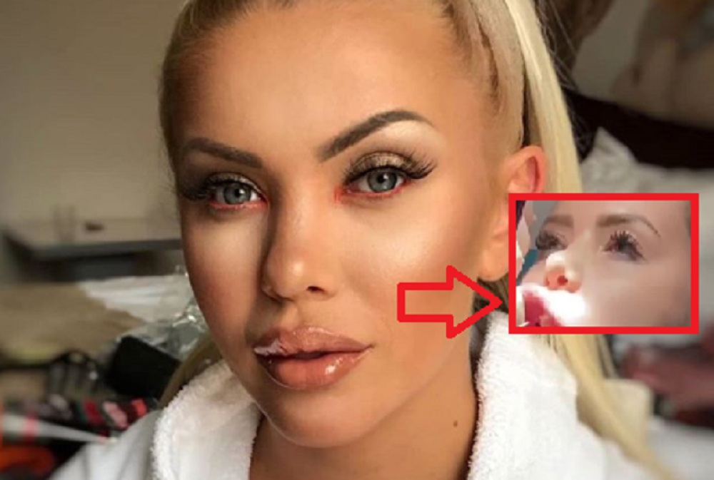 Snimak toka operacije Sanje Stanković - razjapljena usta, uklanjanje dela obraza, igle i makaze u usnoj duplji... (FOTO)