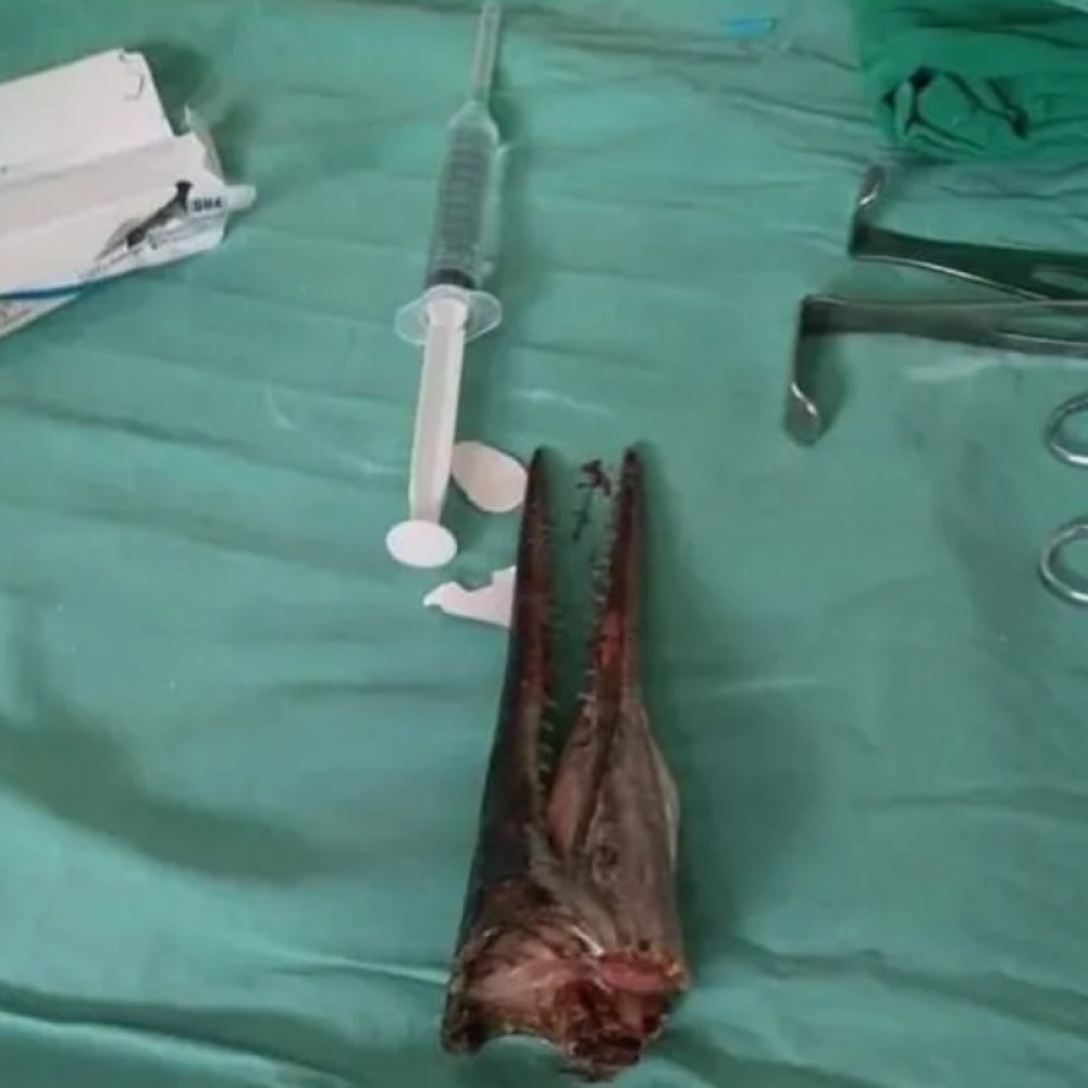 Strašna riba zabola se dečaku u vrat! Doktori nisu smeli da ga operišu! (UZNEMIRIJUĆE FOTOGRAFIJE)