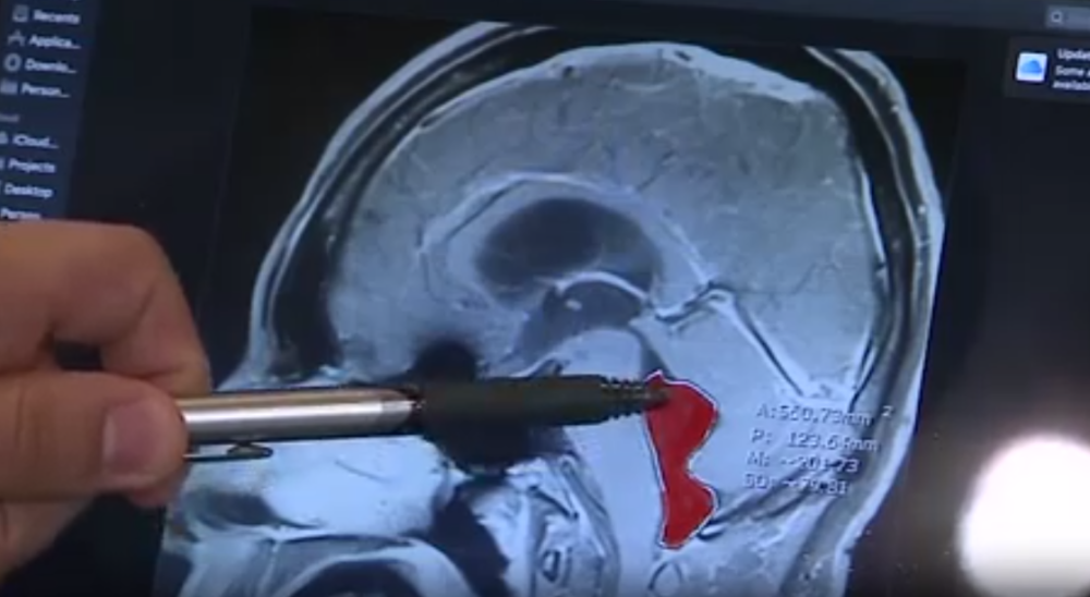 Jelo ga je iznutra! Doktori ne znaju kako nije umro od onoga što mu je bilo u mozgu 10 godina (FOTO/VIDEO)