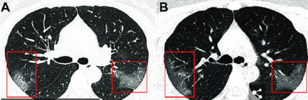 Evo šta se dešava sa plućima pacijenata zaraženih koronavirusom! (FOTO)