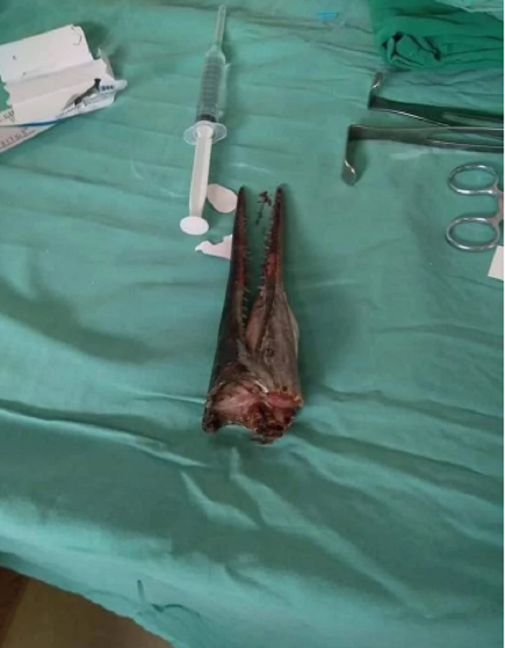 Dečak otišao na pecanje a onda završio u bolnici zbog ribe koja mu se zarila u vrat