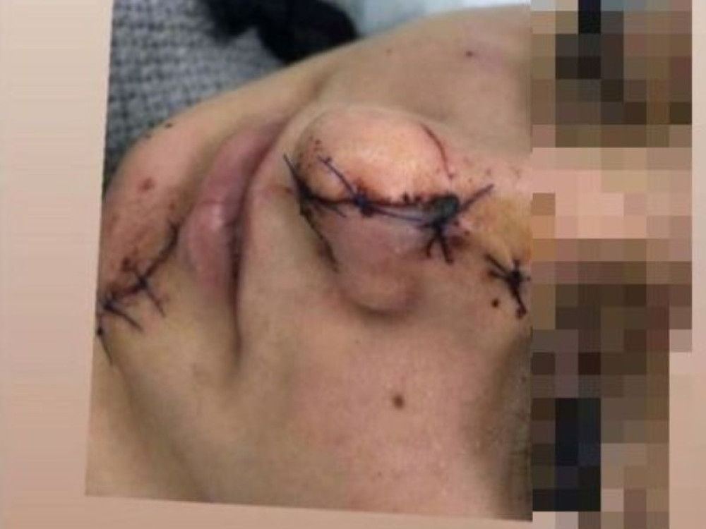 Sudijina ćerka u Prijepolju čašom isekla lice devojci!