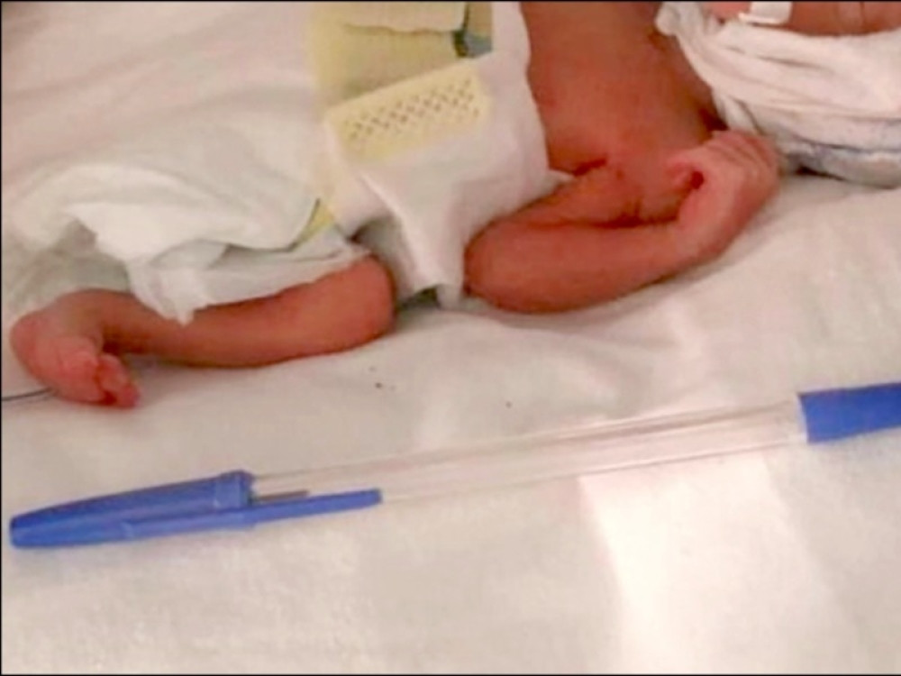 Doktori su zanemeli kada su je ugledali... Beba rođena u veličini hemijske olovke! (FOTO)