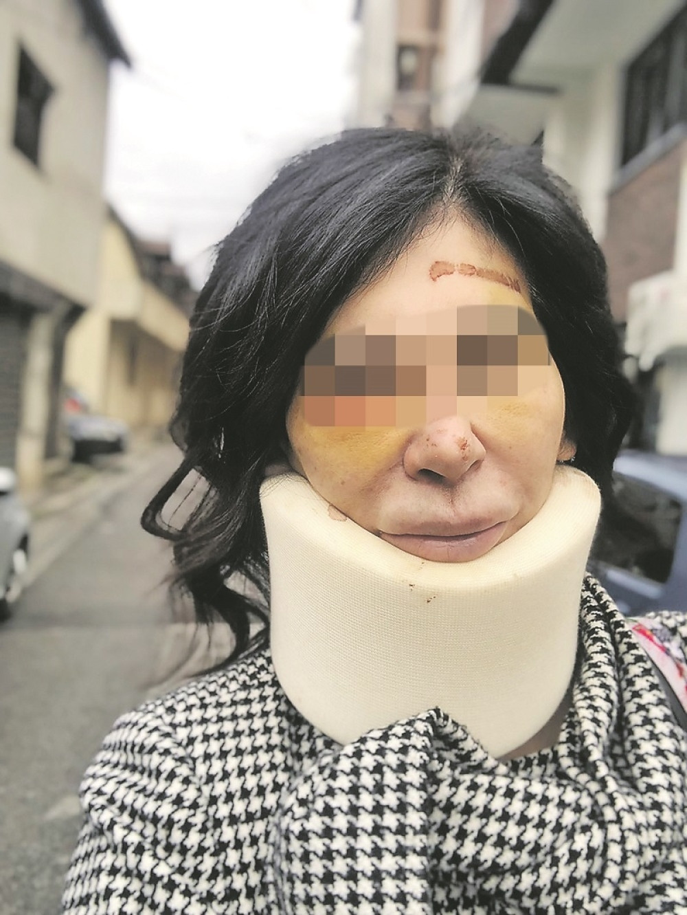 Šiptar unakazio Srpkinju, ona objavila fotografije i poručila: Sve si mi kosti polomio, platićeš!