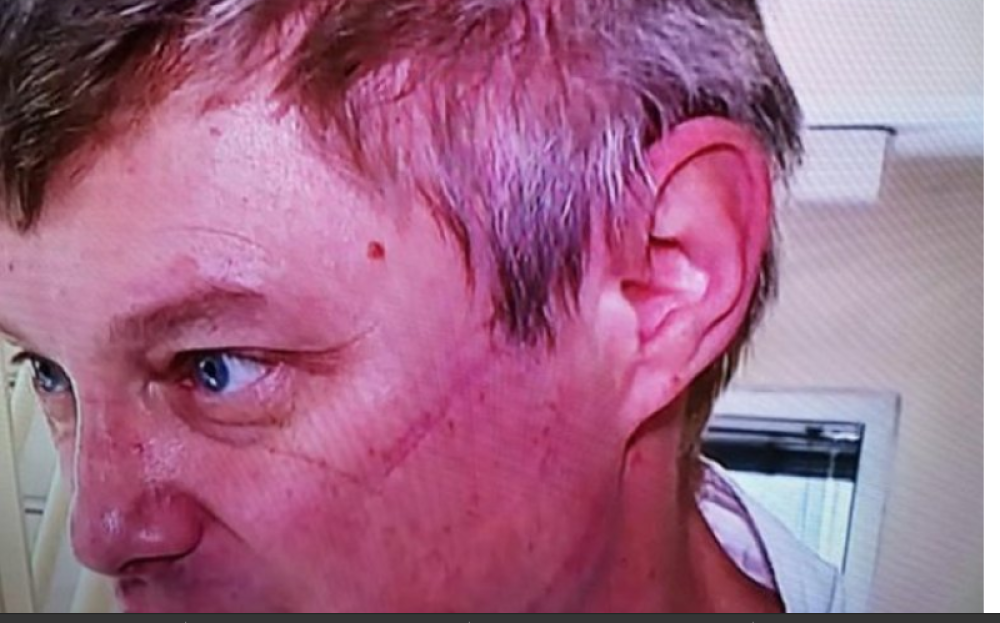 Posle rada sa pacijentima obolelim od korone, doktor Stevanović skinuo zaštitnu opremu - Na njegovom licu bile su rane! (FOTO)