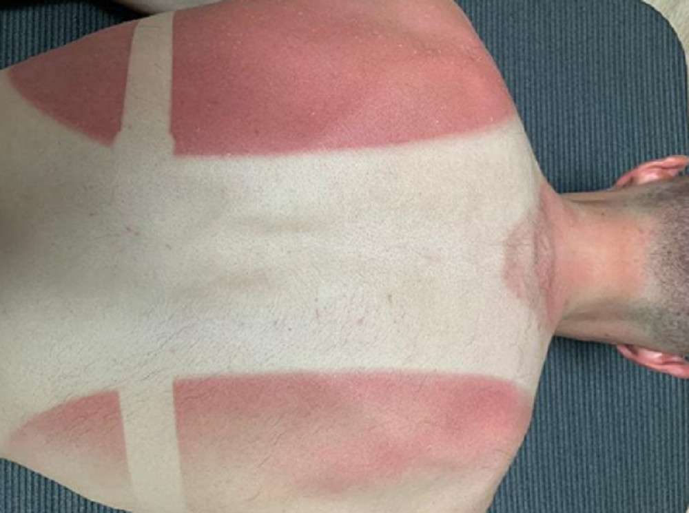 Španac reš pečen od sunca! Leđa mu kao zastava Danske (FOTO)