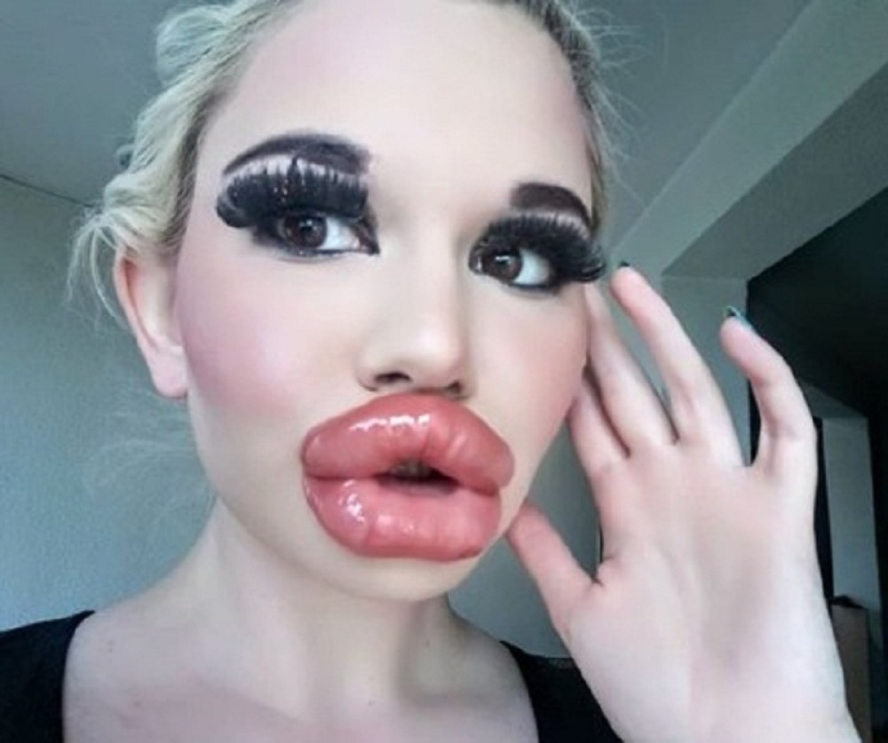 "Prestani s operacijama i plati psihijatra!" Anrea od veličine usana ne može da jede: Ona još ne planira da stane! (FOTO)