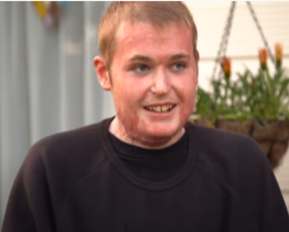 Skoro čitava koža mu je gorela, jedva je ostao živ nakon 25 operacija (VIDEO)