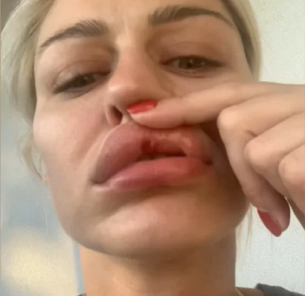 Sandra Obradović pokazala modrice: Manekenka progovorila o jezivom nasilju! (FOTO)