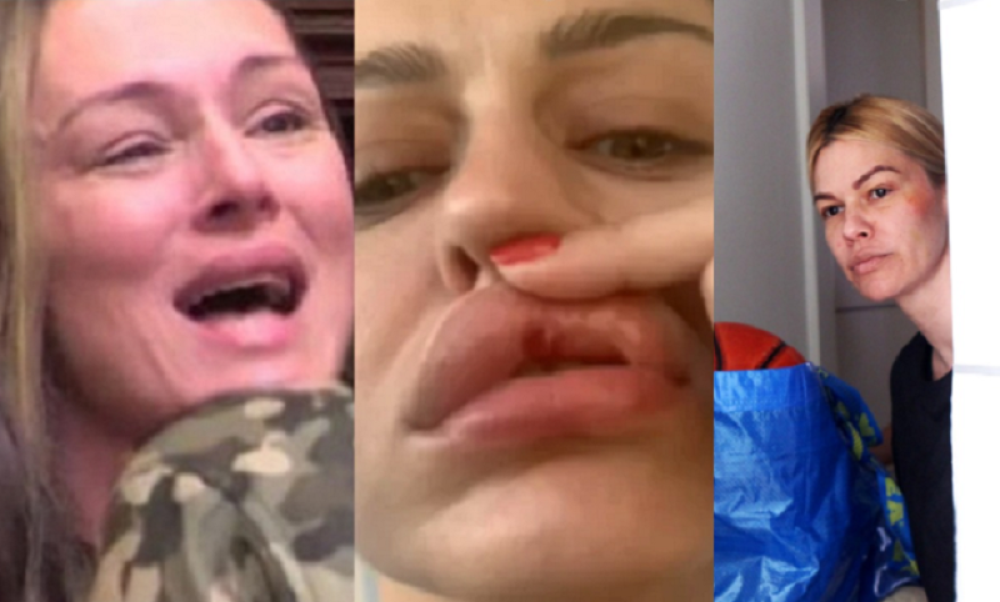 Poznate žene kao žrtve nasilja: Tukao me je do te mere, da sam morala da idem na magnetnu rezonancu