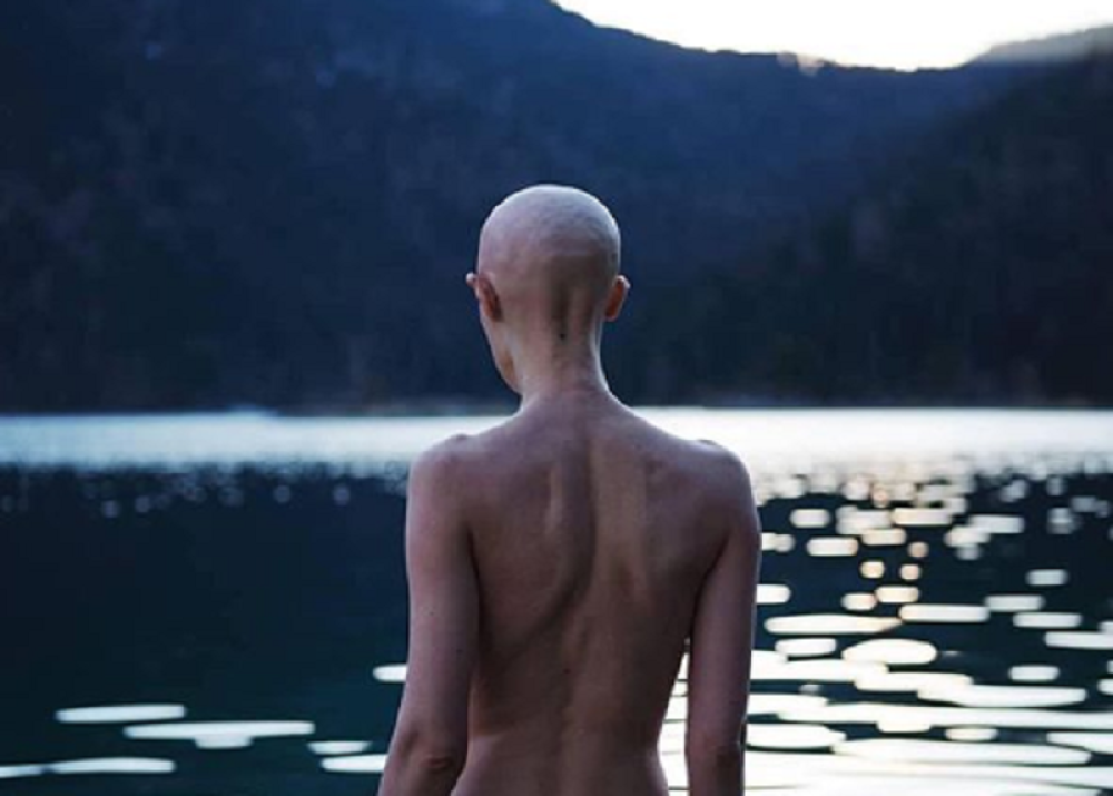 Zbog opake bolesti opala joj kosa, a zubi ispali: Melani (32) uprkos genetskom poremećaju je jedan od najplaćenijih modela na svetu! (FOTO)