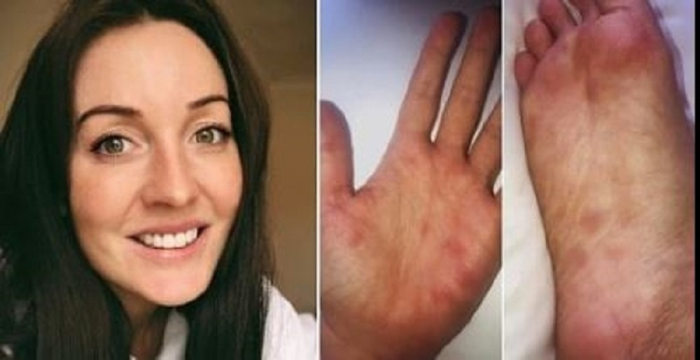 Sara primetila osip po nogama, prvo mislila da ima HIV, a onda otkrila pravu istinu