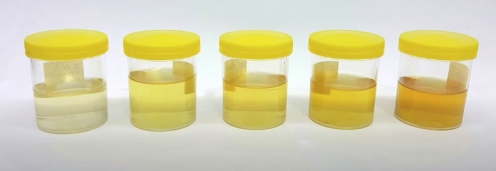 Šta boja urina govori o vašem zdravlju?