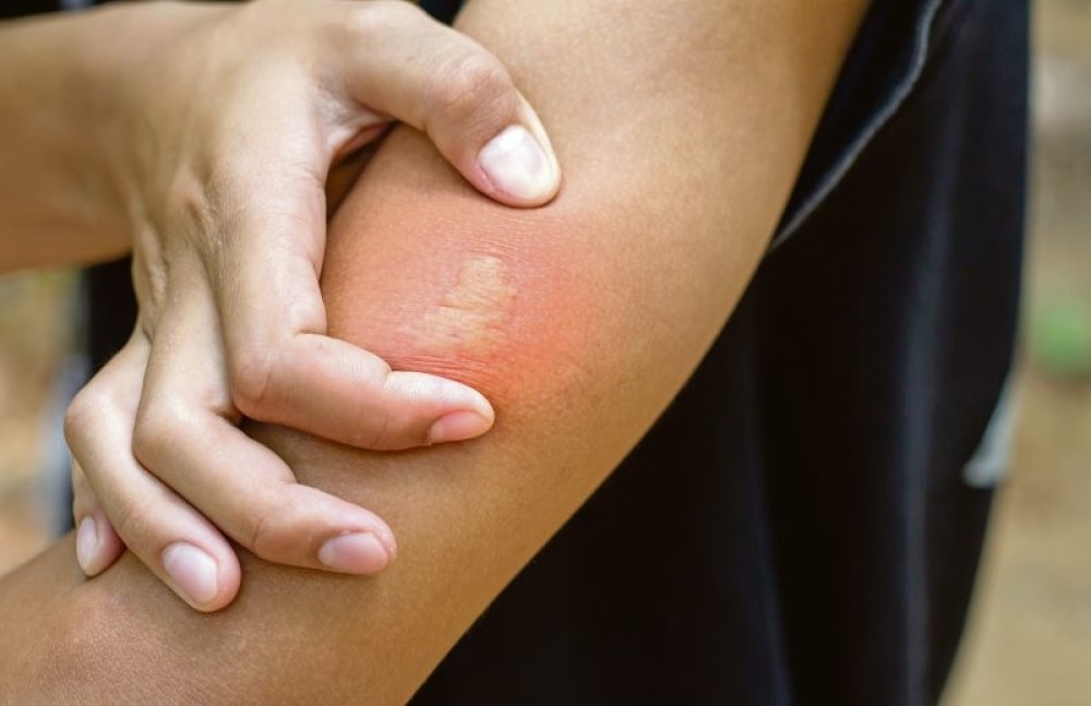 Šta je najbolje uraditi ako vas ujede osa