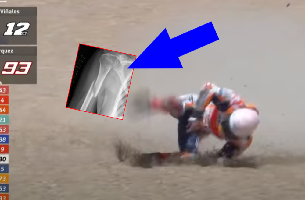 Prelom ruke Marka Markeza proganjaće sportsku publiku danima, šampion nije zaslužio ovakav horor (FOTO)