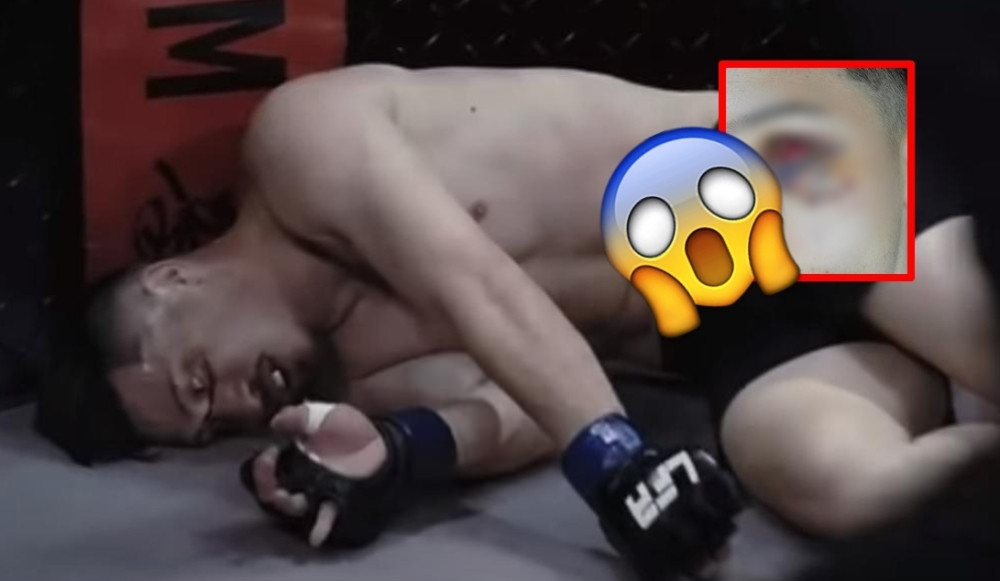 Zbog podmuklog poteza protivnika umalo ostao bez oka! Ostao krvav na zemlji i pobedio! (FOTO/VIDEO)