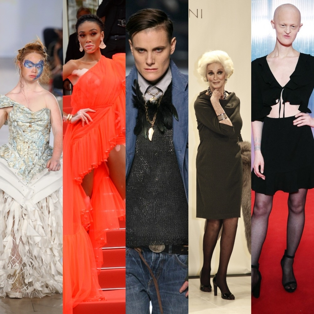 Anomalije, bolesti i poremećaji, a najplaćenije su u svetu mode (FOTO)