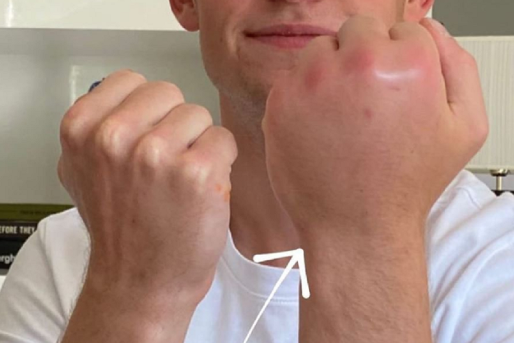 Otekla leva šaka fudbalera Barselona, postala mu duplo veća od desne! Razlog je skroz čudan (FOTO)