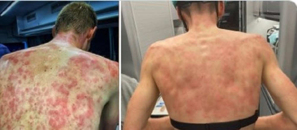 Modri i puni plikova: Nevreme ostavilo ozbiljne posledice po leđa biciklista (FOTO, VIDEO)