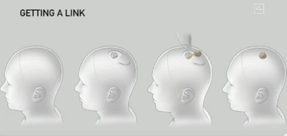Evo šta se krije iza suludog plana milijardera! Posle svinje i ljudima će ugraćivati čipove u mozak!