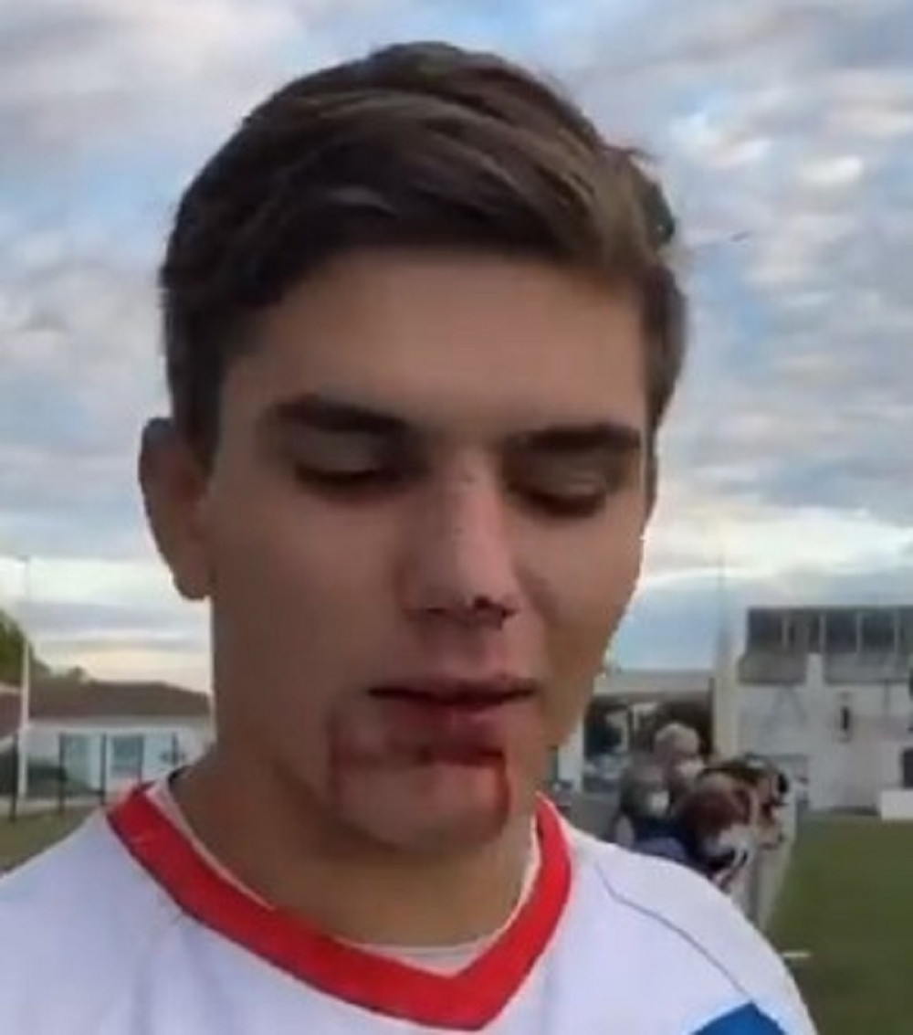 Umesto na usta voda mu izlazi na rupu nastalu povredom (VIDEO)