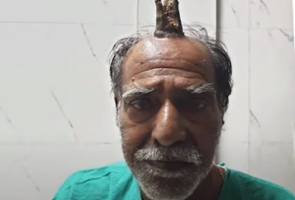 U početku je bila samo kvrga, a kada više nije mogao da je krije, hirurzi su se ZALEDILI! (VIDEO)