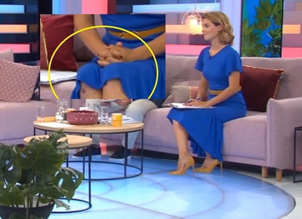 Voditeljka jutarnjeg programa sva u modricama: Kada se haljina podigla video se užas na njenim kolenima (FOTO)