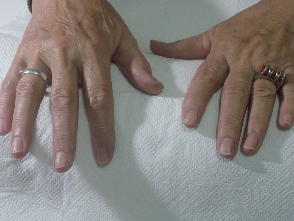 Promene na noktima, mogu ukazati na opaku bolest!