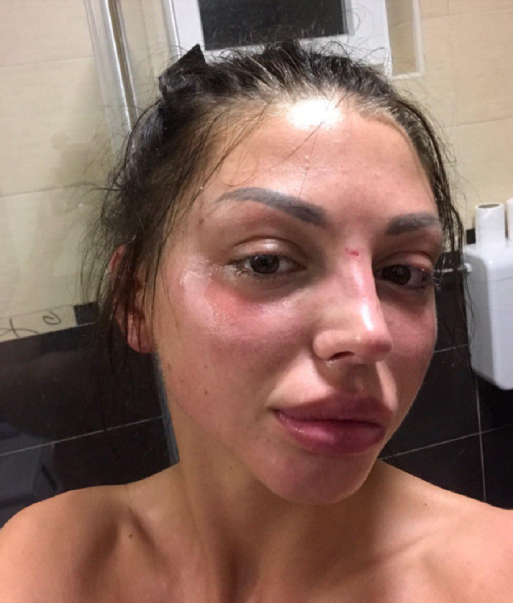 Maja Marinković pokazala UNAKAŽENO lice: Janjuš je UBIO od BATINA? (FOTO)