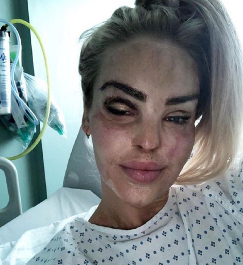 Popularnoj voditeljki dečko UNAKAZIO lice KISELINOM! (FOTO)