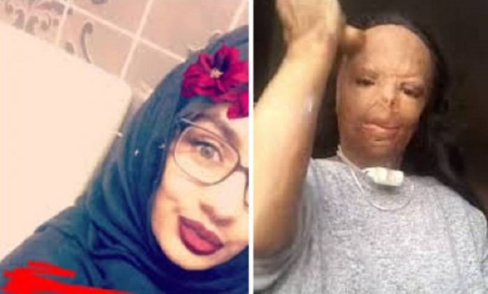 Napravila glupu grešku, bila u komi dva meseca i izgubila sedam prstiju (VIDEO)