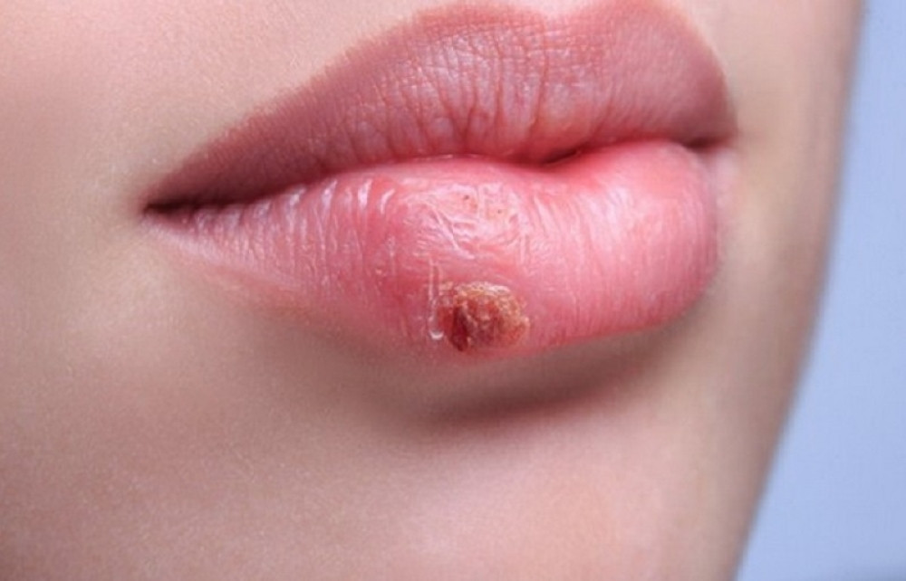 Virus herpesa odgovoran za autizam!?