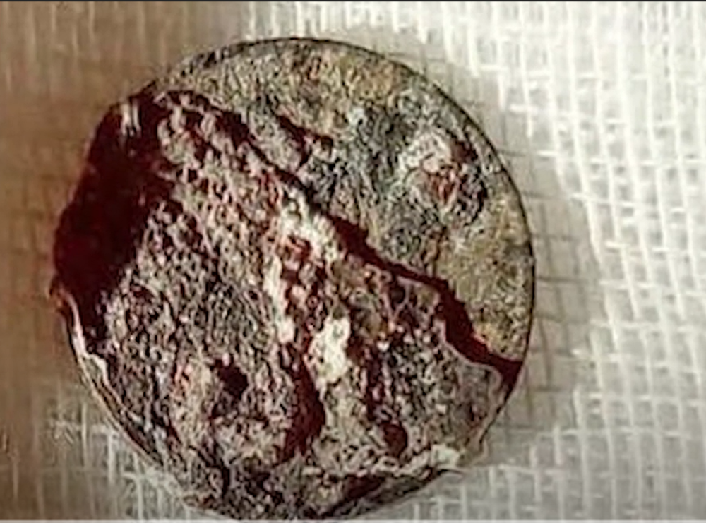 Sasvim slučajno mu u nosu pronašli novčić koji je tamo "zaturio" još kao dečak (VIDEO)