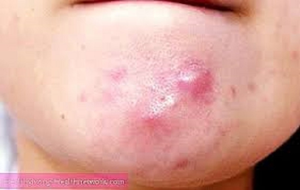 Iscedio bubuljicu na licu i umalo umro! Evo zašto nikad ne sme da se dira "trougao smrti"